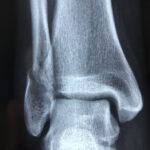 「憂鬱症的症狀及其類型」:了解憂鬱症的不同表現方式 7 radiography 3057768 960 720