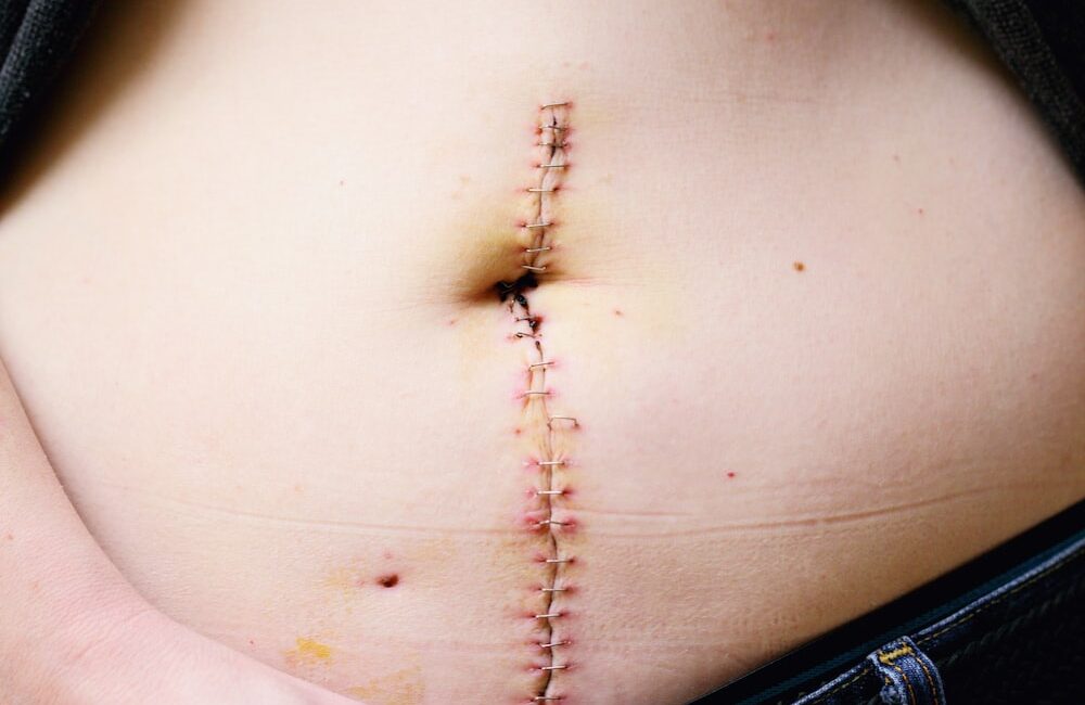 痛風知識普及：了解症狀、診斷和漸進性治療